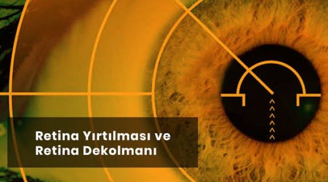 Retina Dekolmanı Tedavisi Mümkün müdür?